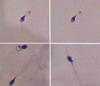 关于患者对阴囊湿疹的常见疑问解答